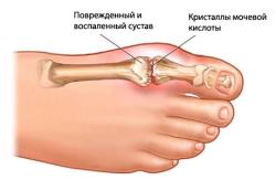Лечение подагры